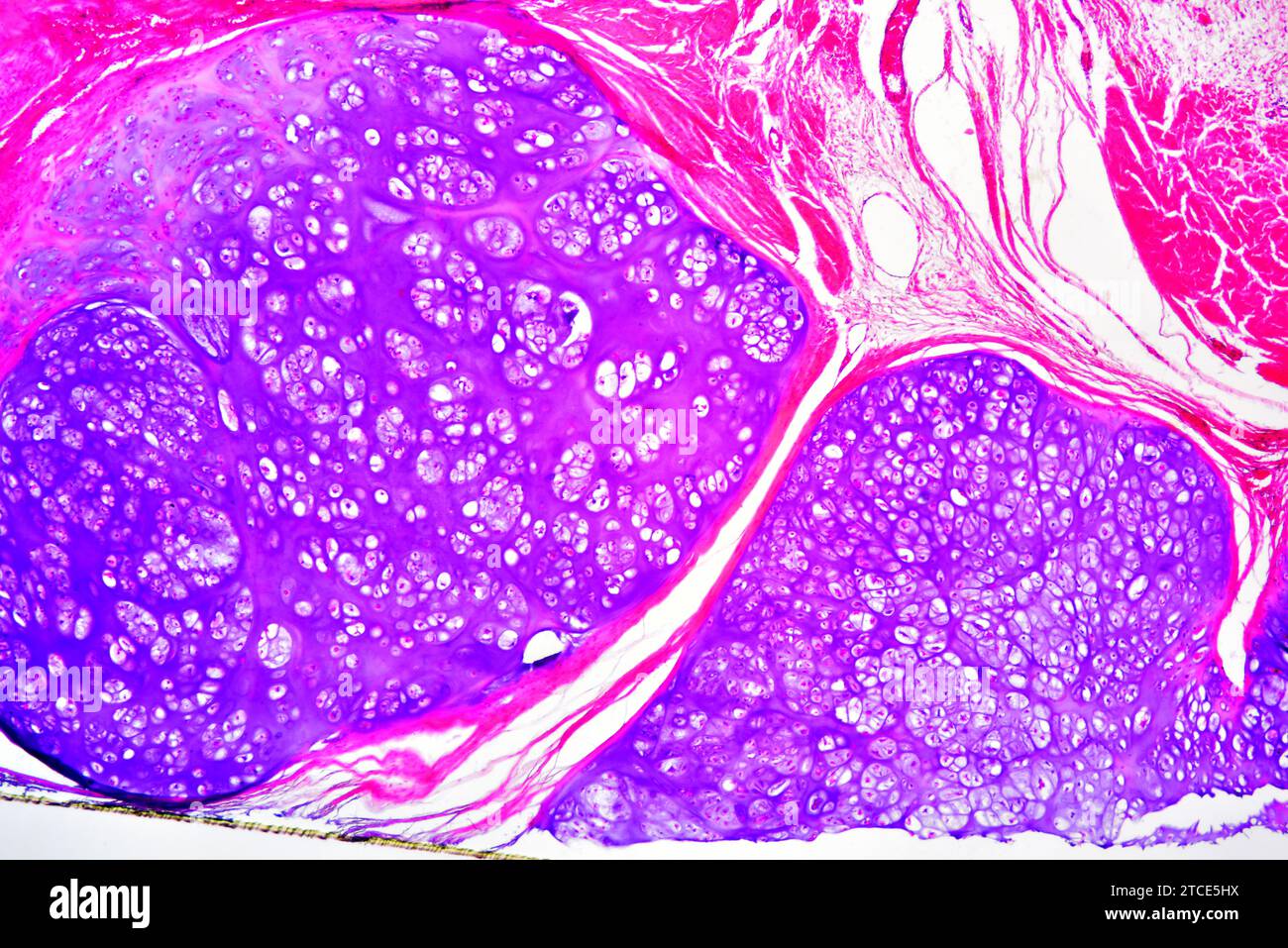 Condrosoma osseo pubico umano (tumore benigno) che mostra condrociti e matrice. Microscopio ottico X40. Foto Stock