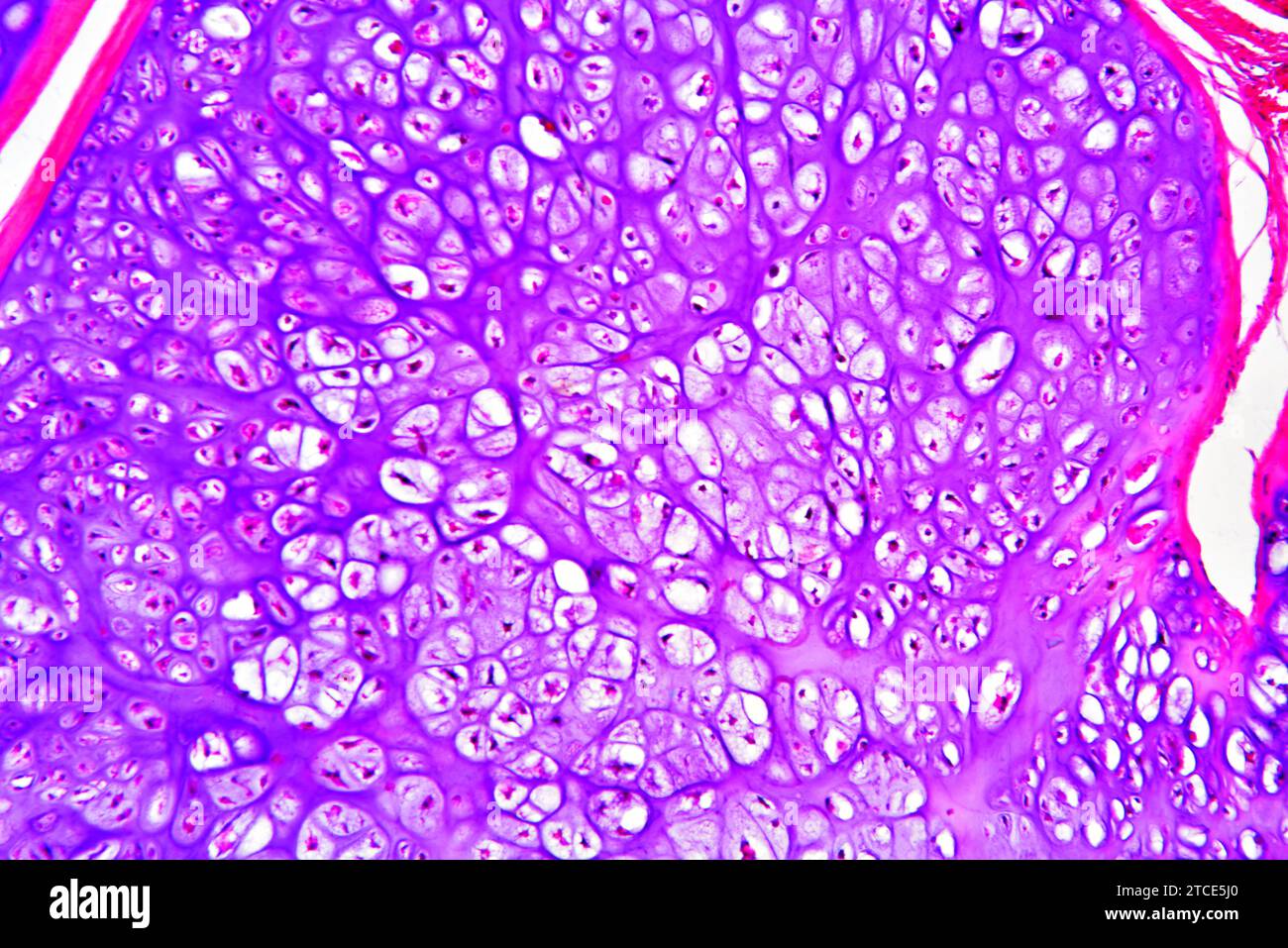 Condrosoma osseo pubico umano (tumore benigno) che mostra condrociti e matrice. Microscopio ottico X100. Foto Stock