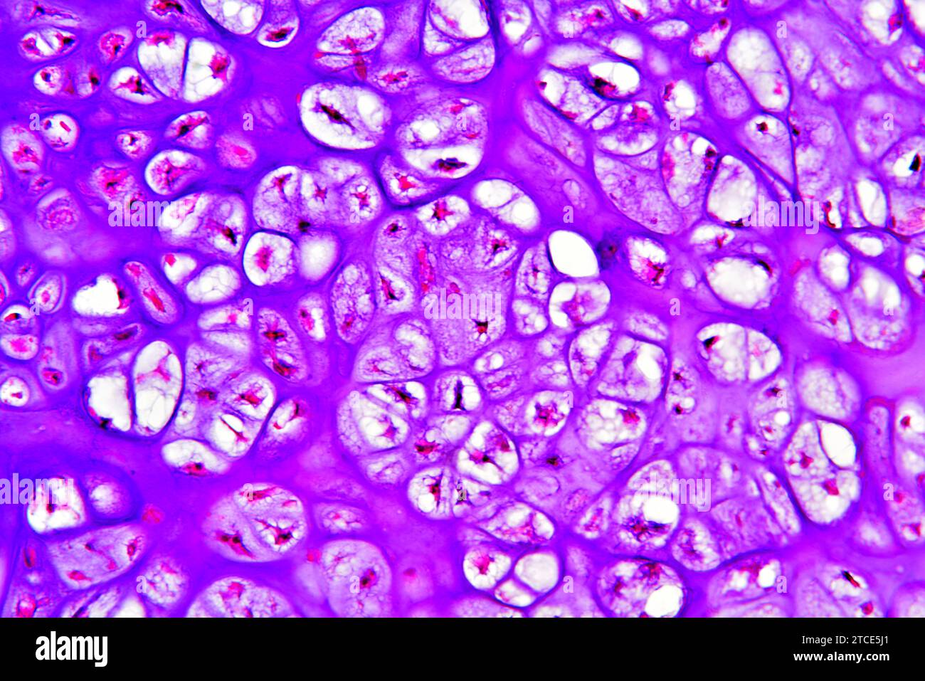 Condrosoma osseo pubico umano (tumore benigno) che mostra condrociti e matrice. Microscopio ottico X200. Foto Stock