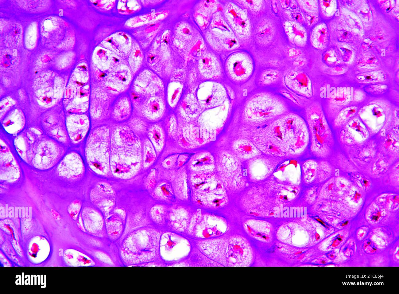 Condrosoma osseo pubico umano (tumore benigno) che mostra condrociti e matrice. Microscopio ottico X200. Foto Stock