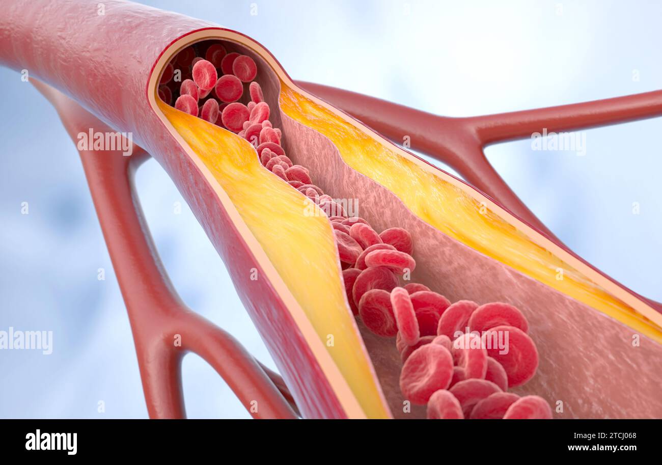 Malattia da aterosclerosi. Colesterolo nei vasi sanguigni. placca aterosclerotica, cellule del sangue, pressione sanguigna. Rendering 3D. Illustrazione 3D. Foto Stock