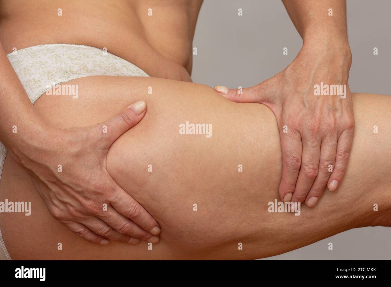 Corpo femminile corto con le mani sulla gamba che preme la pelle per mostrare la cellulite Foto Stock