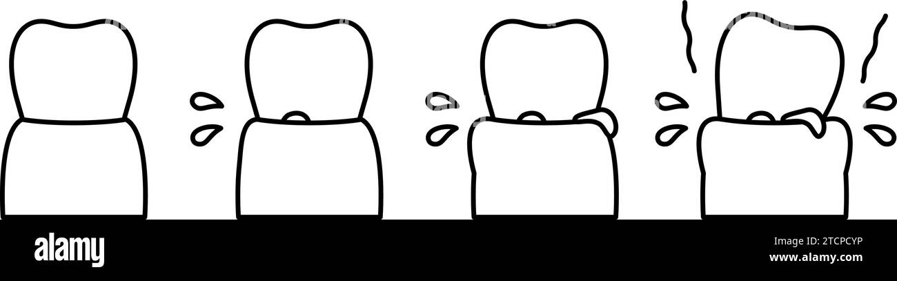 Illustrazione dell'immagine di progressione della malattia parodontale, semplice disegno di linee, illustrazione vettoriale Illustrazione Vettoriale