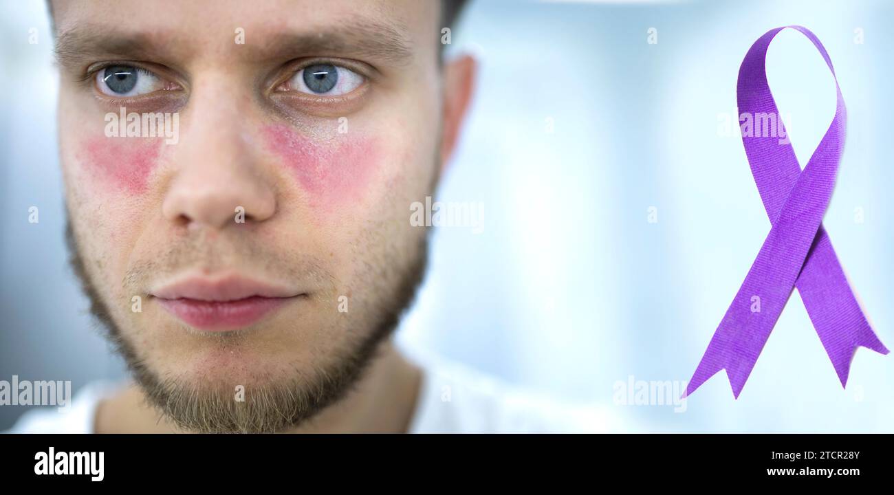 Uomo che soffre di lupus, simbolo di consapevolezza del nastro viola cancro pancreatico, malattia di Alzheimer, epilessia, lupus, giornata mondiale del cancro Foto Stock