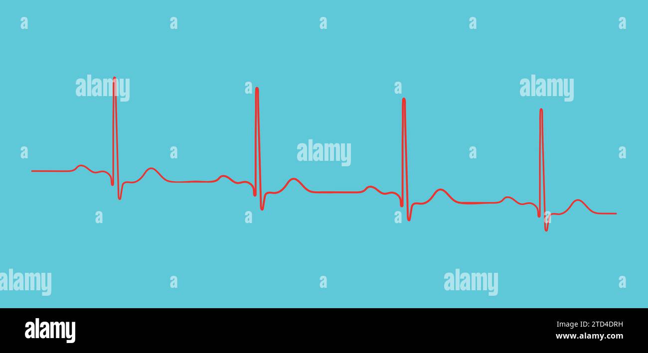 Ripolarizzazione ventricolare, ciclo cardiaco, ECG cardiaco nel ritmo sinusale normale, intervallo QT dell'ECG. Illustrazione Vettoriale