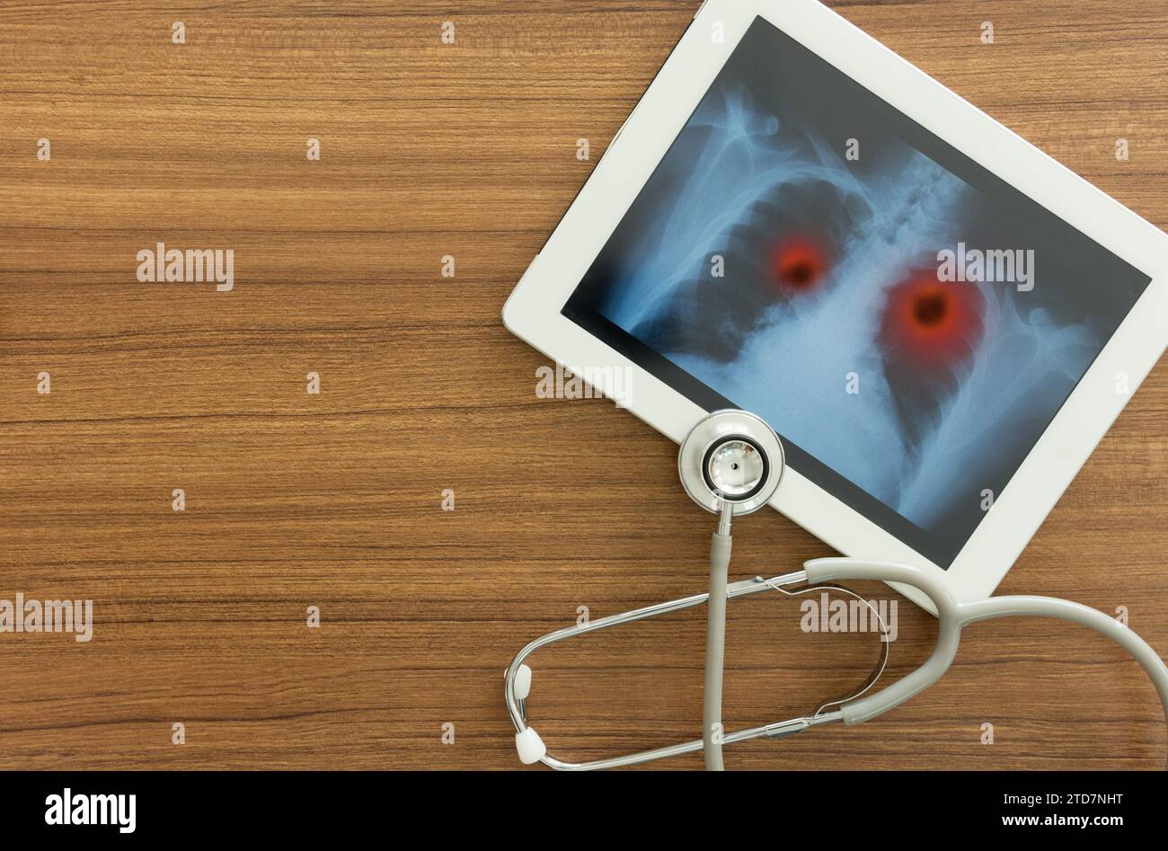 immagine radiografica del cancro polmonare in tablet computer e stetoscopio sulla scrivania del medico radiologo. vista dall'alto. Concetto medico. Foto Stock