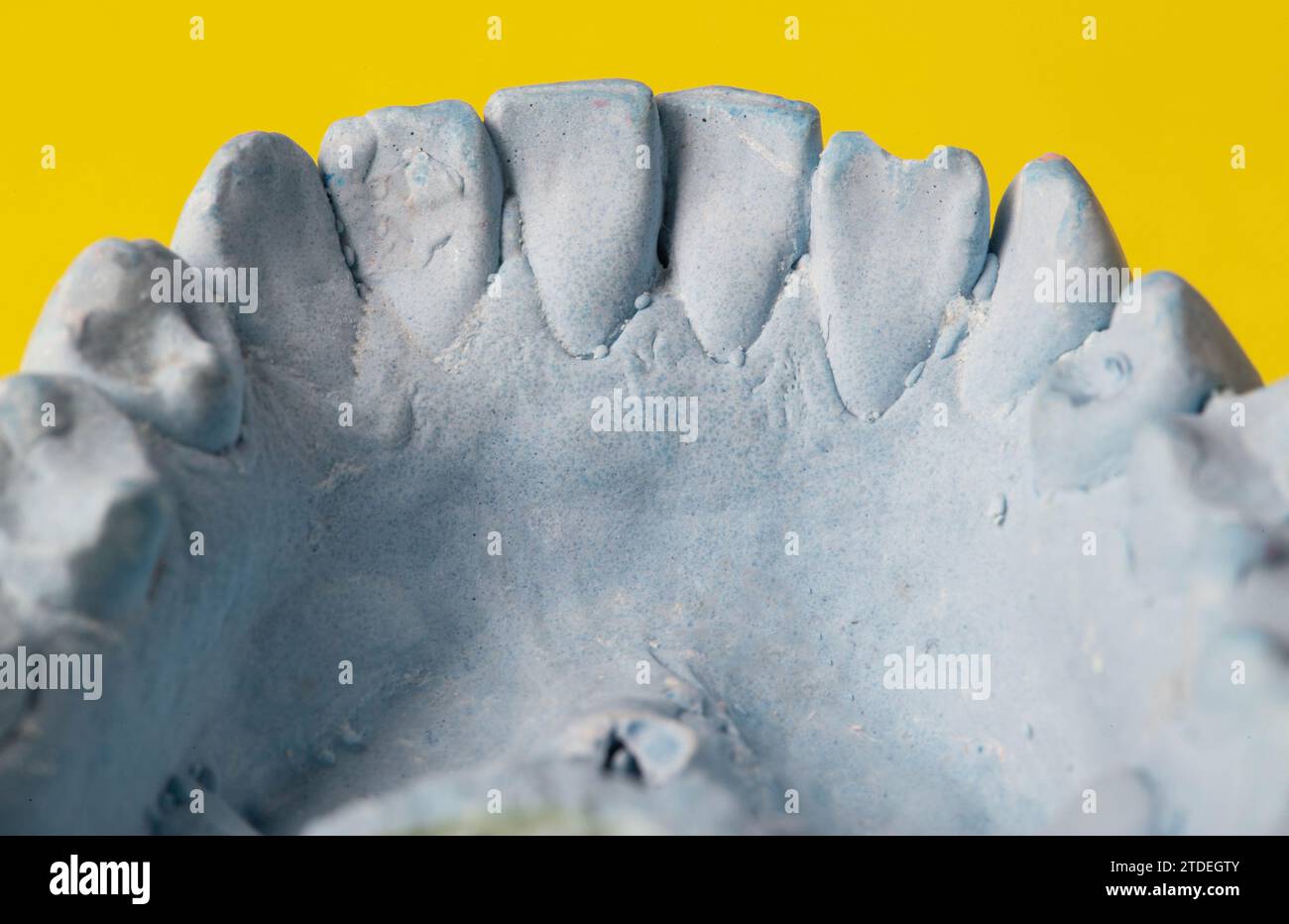 Intonaco blu impressione della mascella dentale di un paziente con denti storti e malocclusioni su sfondo giallo. Produzione di controventature per correggere il morso Foto Stock