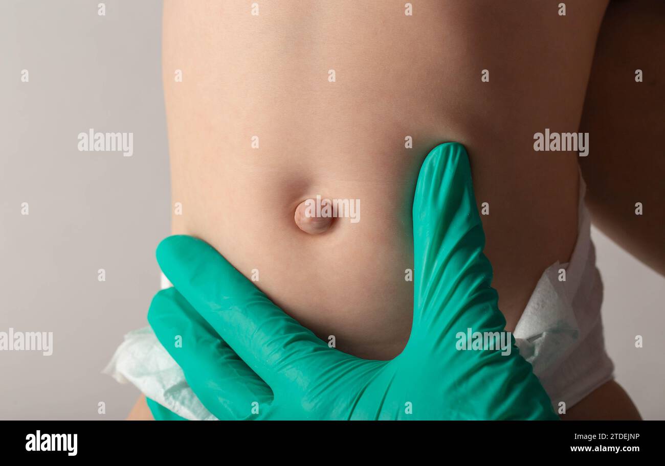 Un medico chirurgo in guanti medici esamina l'addome di un neonato con un anello ombelicale ingrossato e un'ernia ombelicale, primo piano. Foto Stock