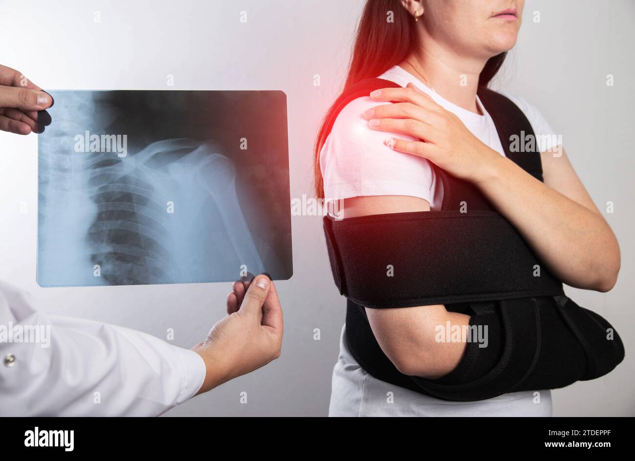 Il medico tiene in mano una radiografia medica di un omero dislocato e di una frattura della clavicola sullo sfondo di una ragazza paziente la cui spalla Foto Stock