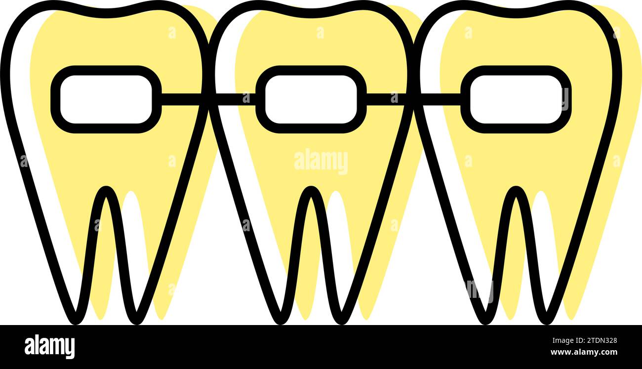 Odontoiatria: Apparecchi ortodontici e staffe metalliche utilizzate per raddrizzare i denti, illustrazione vettoriale Illustrazione Vettoriale