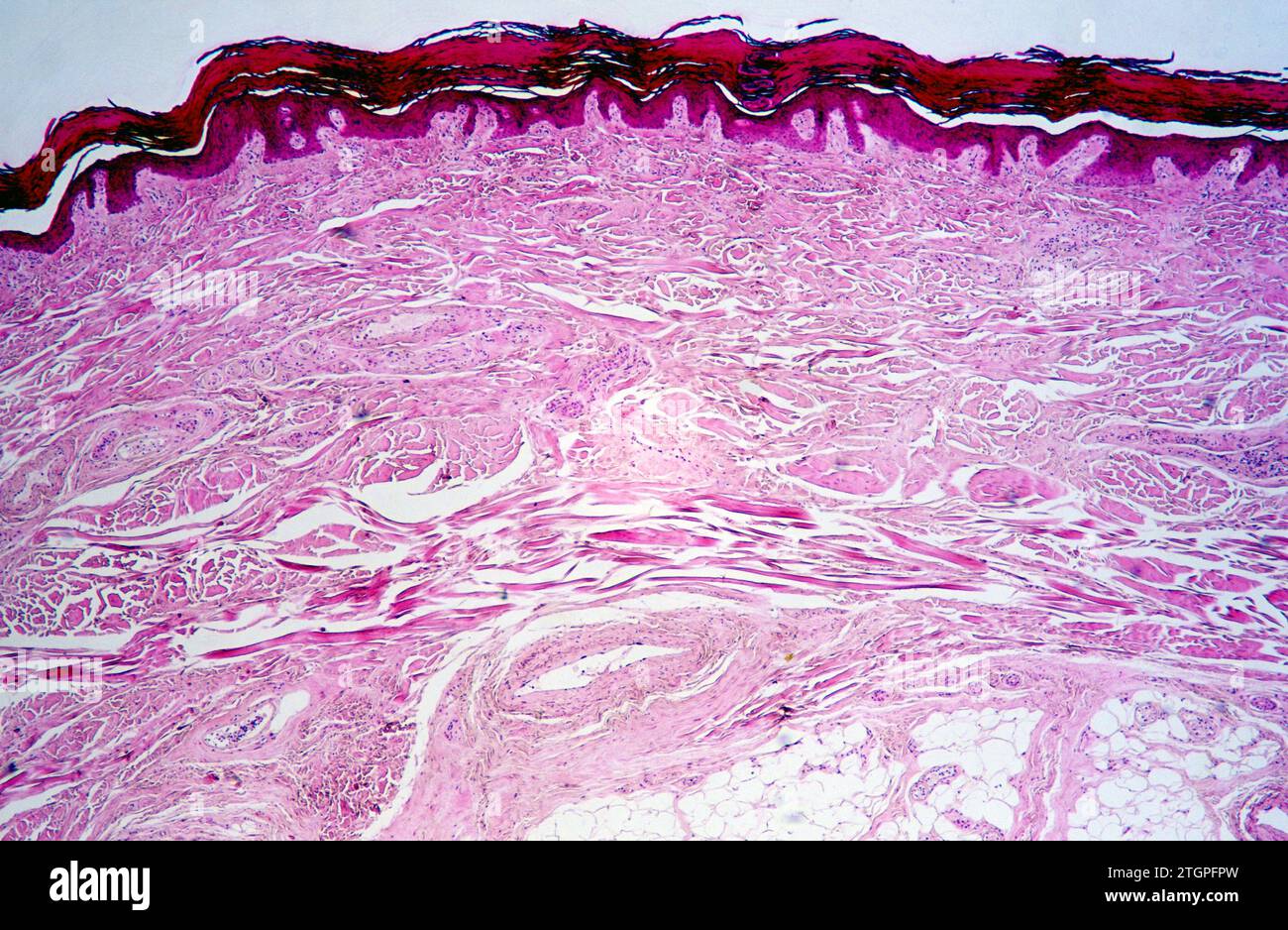 Sezione umana del dito che mostra epidermide (epitelio squamoso stratificato), derma e tessuti connettivi. Fotomicrografia. Foto Stock