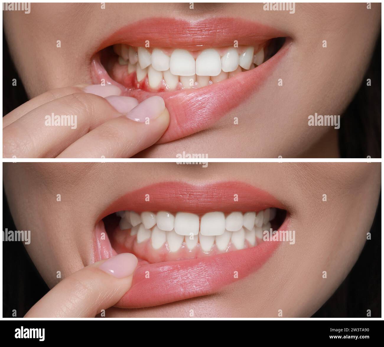 Donna che mostra gomma prima e dopo il trattamento, collage di foto Foto Stock