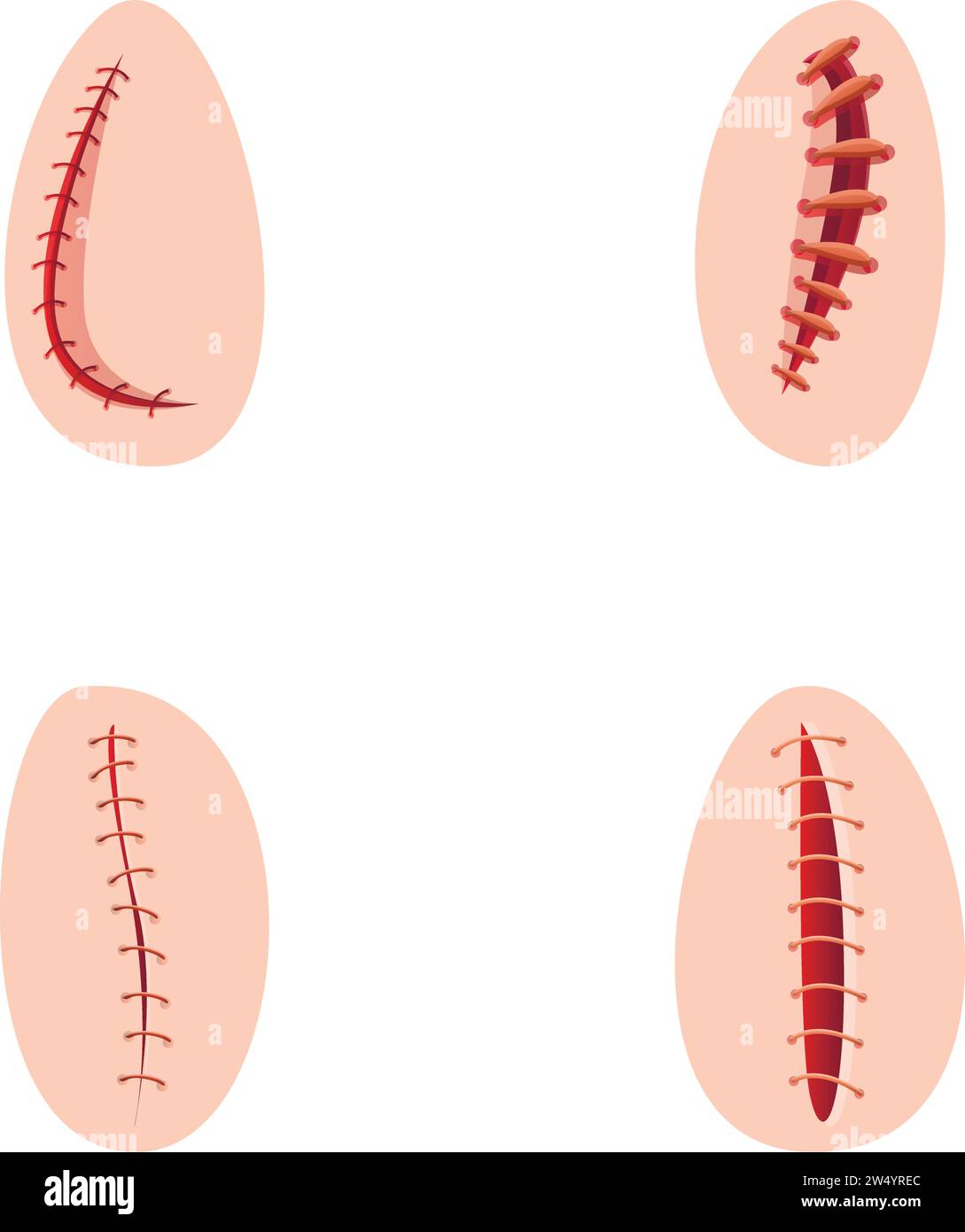 Le icone di sutura operative impostano il vettore dei cartoni animati. Vari tipi di sutura chirurgica. Chirurgia, concetto di medicina Illustrazione Vettoriale