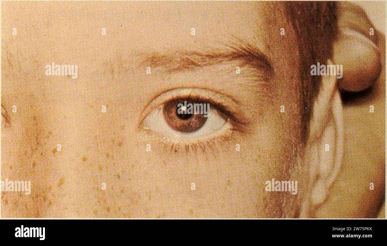 Malattia di wilsonss immagini e fotografie stock ad alta risoluzione