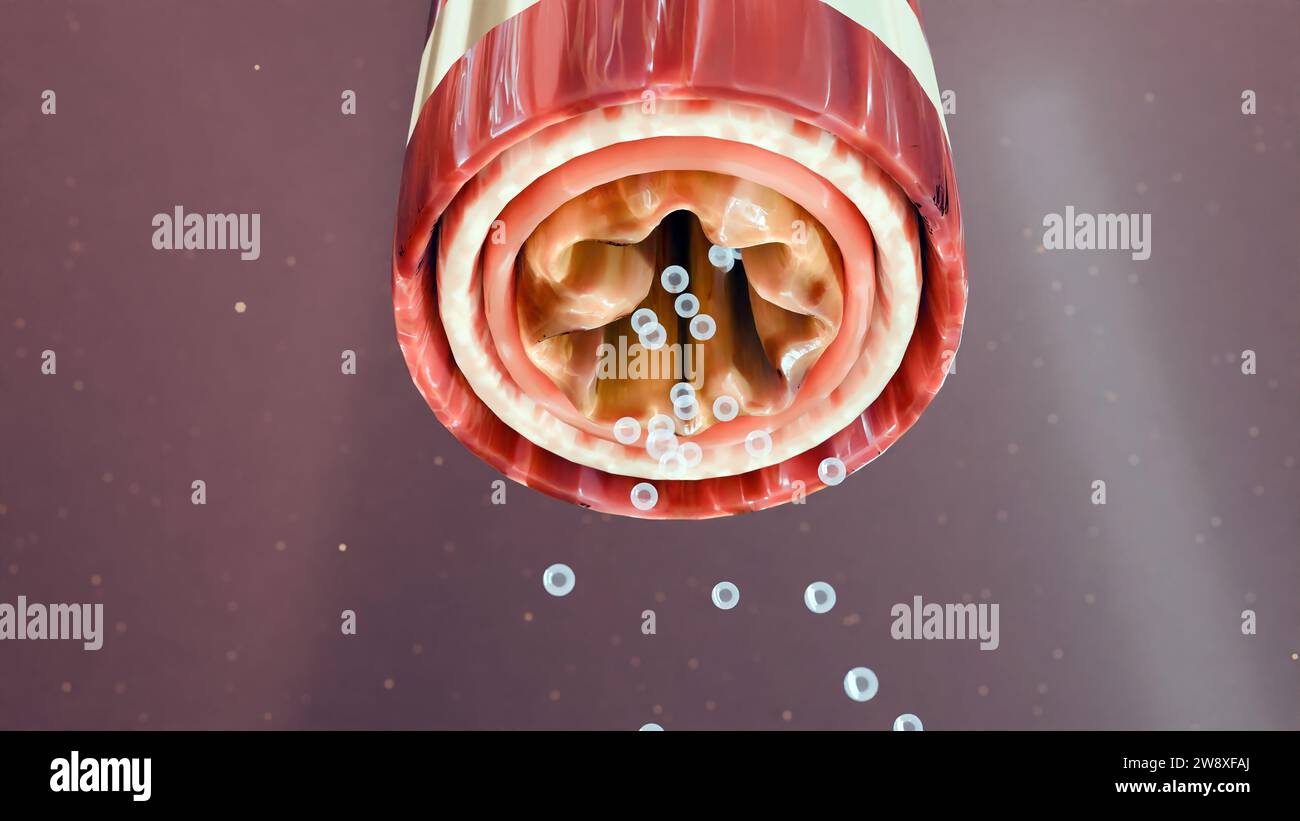 Sintomi di asma, trattamento, Bronchiolo, rendering 3d. Foto Stock