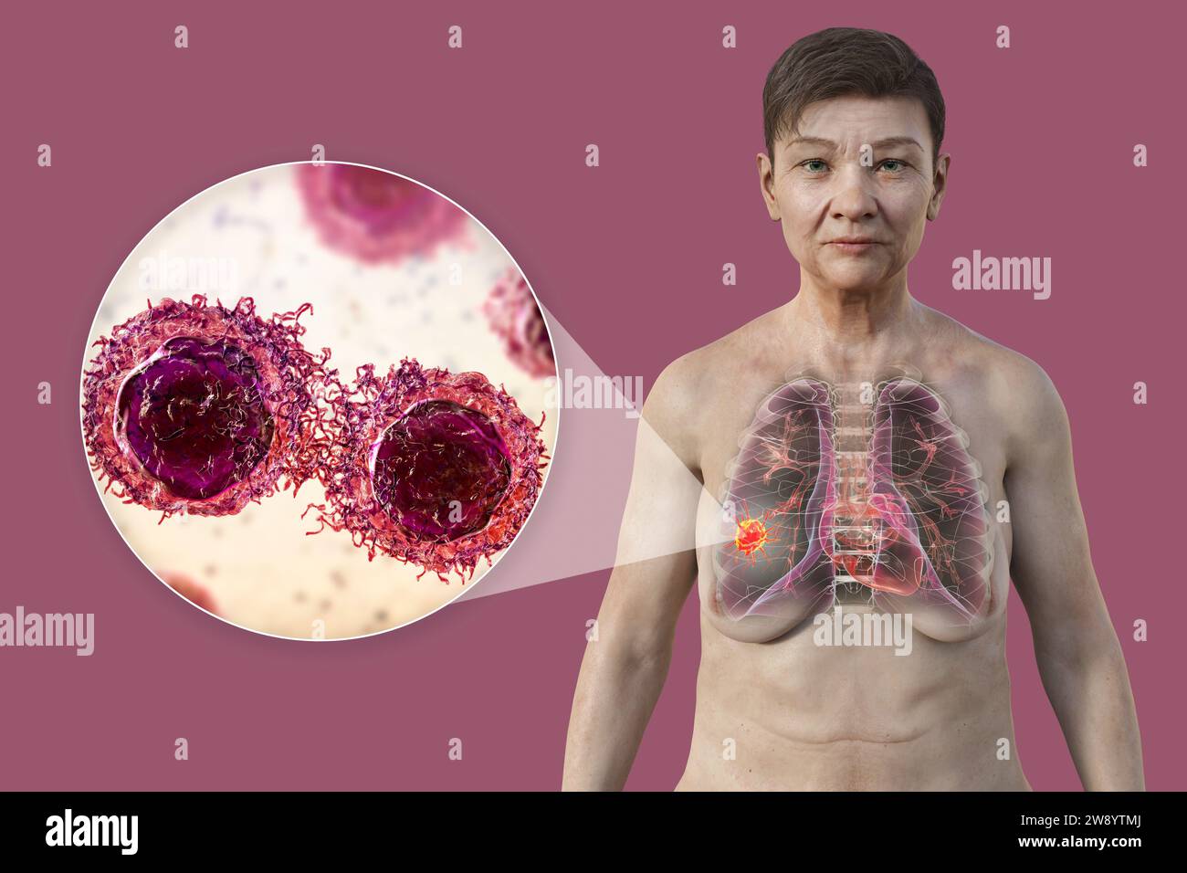 Donna con cancro ai polmoni, illustrazione Foto Stock