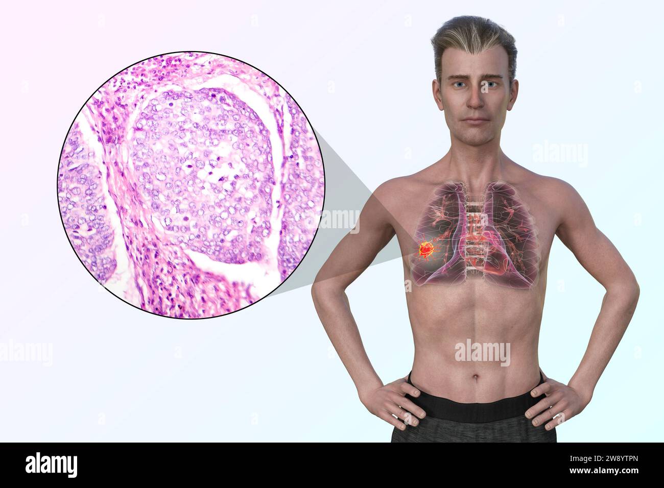 Uomo con cancro ai polmoni, illustrazione Foto Stock