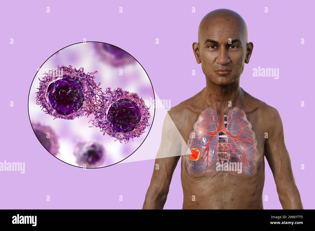 Uomo con cancro ai polmoni, illustrazione Foto Stock