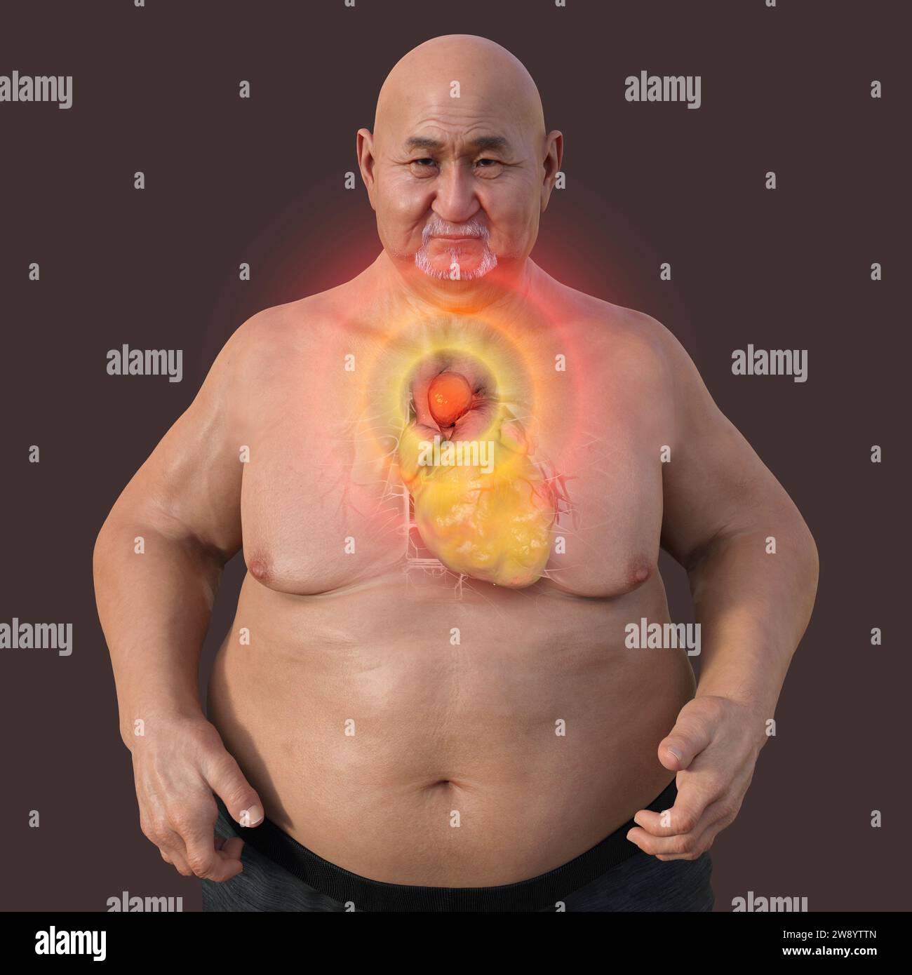 Uomo obeso con aneurisma aortico ascendente, illustrazione Foto Stock