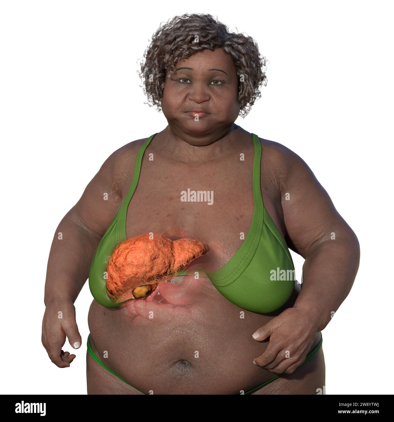 Illustrazione con una donna in sovrappeso con pelle trasparente, che mostra il fegato ed evidenzia la presenza di steatosi epatica. Foto Stock