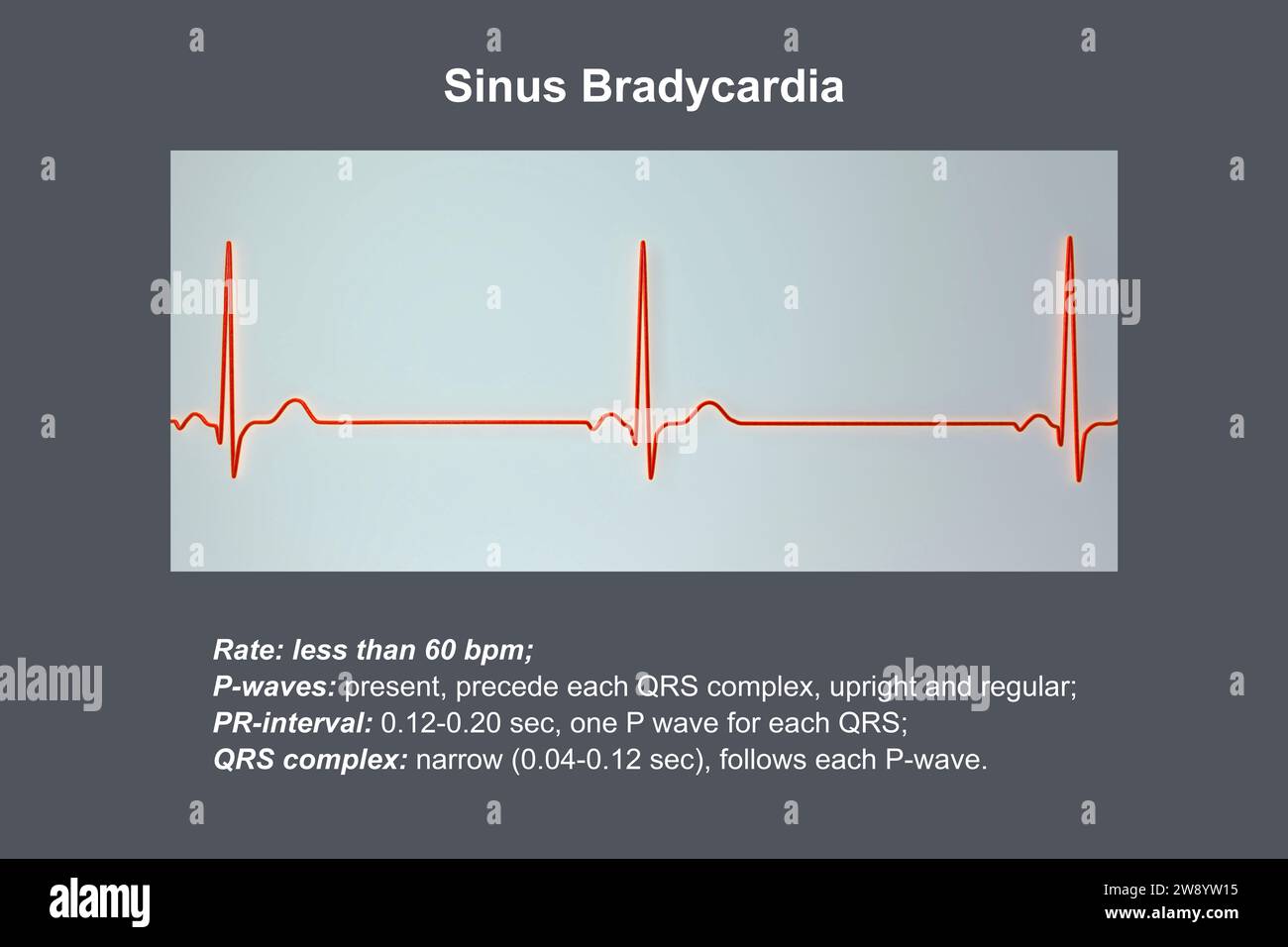 Bradicardia sinusale ritmo cardiaco, illustrazione Foto Stock