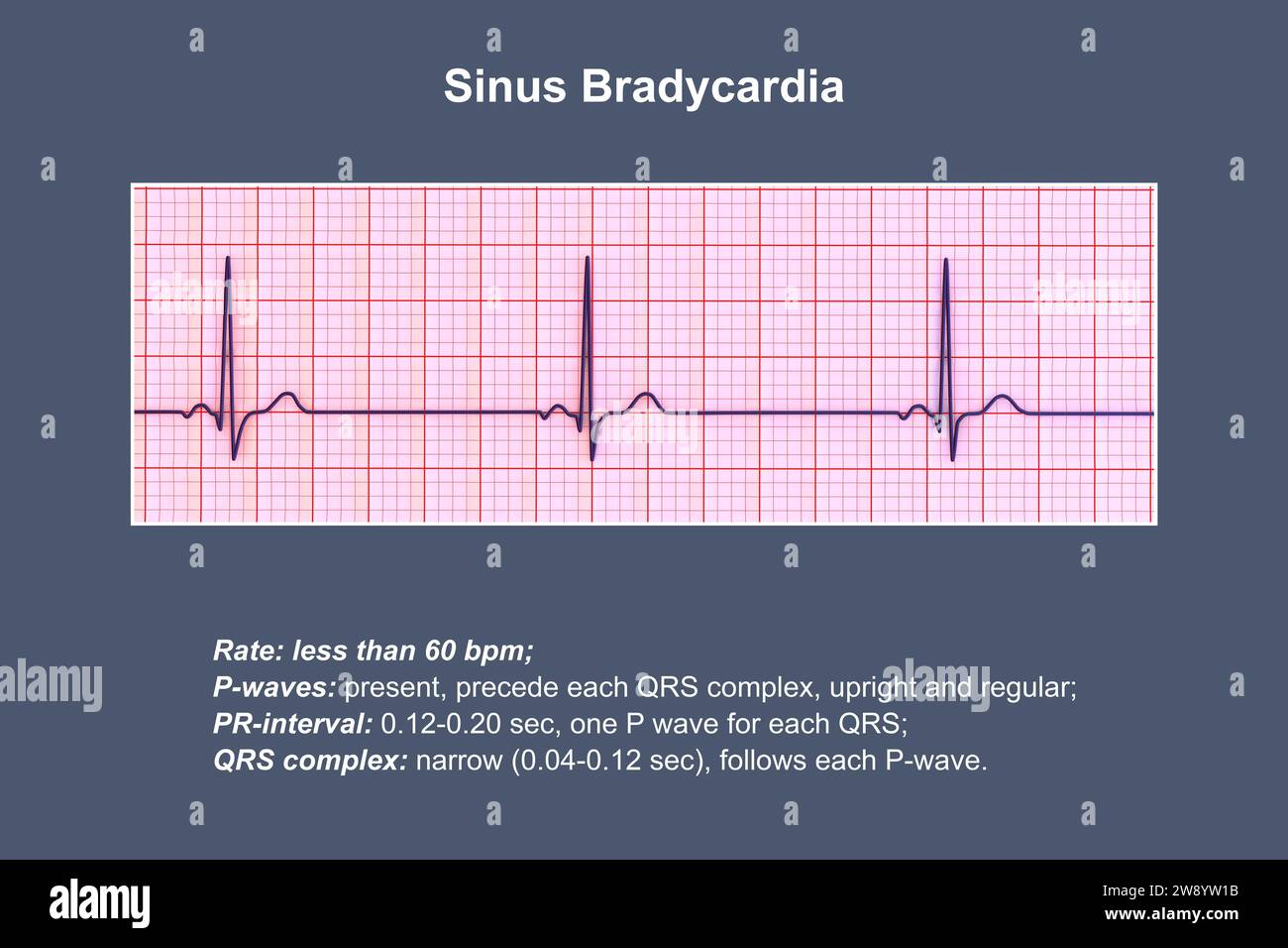 Bradicardia sinusale ritmo cardiaco, illustrazione Foto Stock