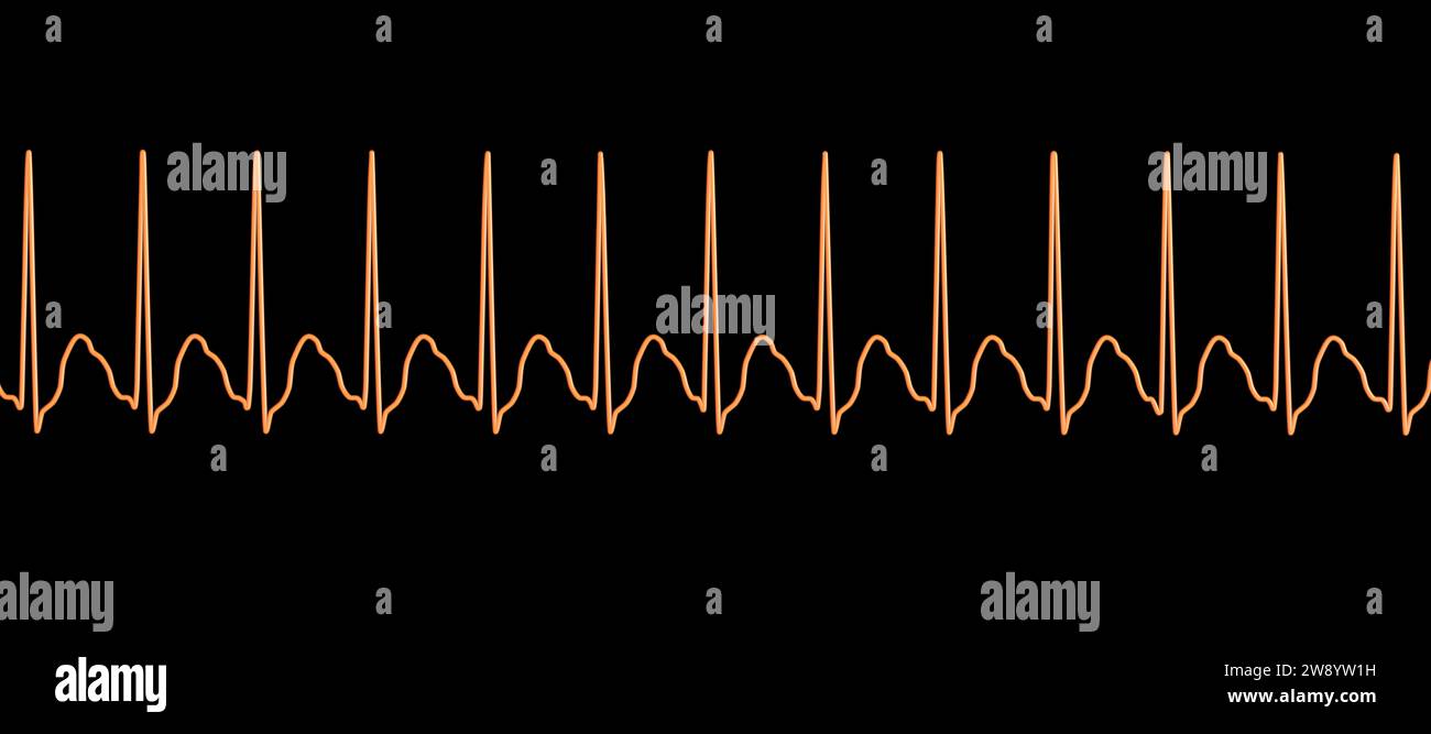 Tachicardia sopraventricolare ritmo cardiaco, illustrazione Foto Stock