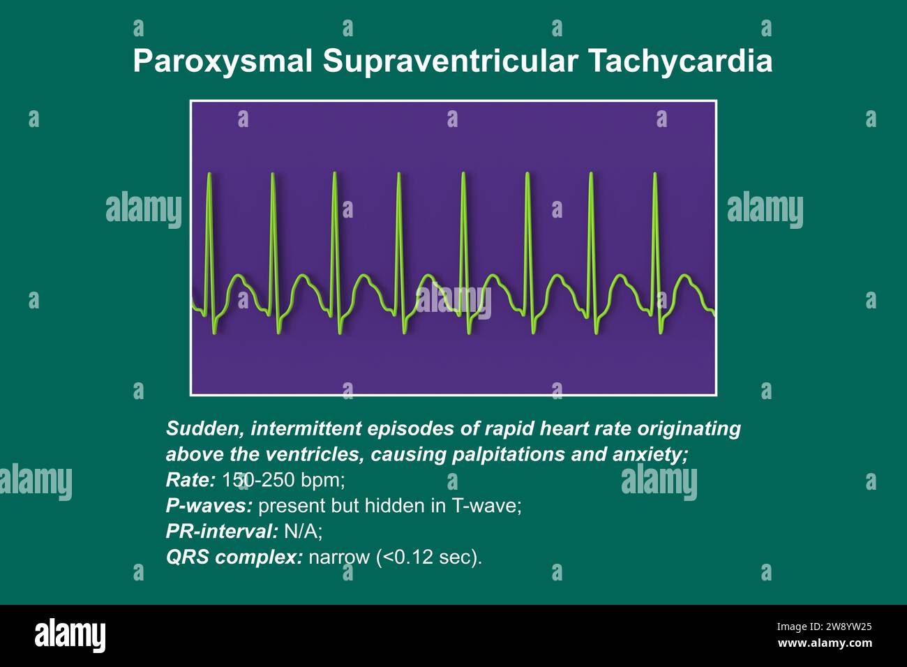 Tachicardia sopraventricolare ritmo cardiaco, illustrazione Foto Stock