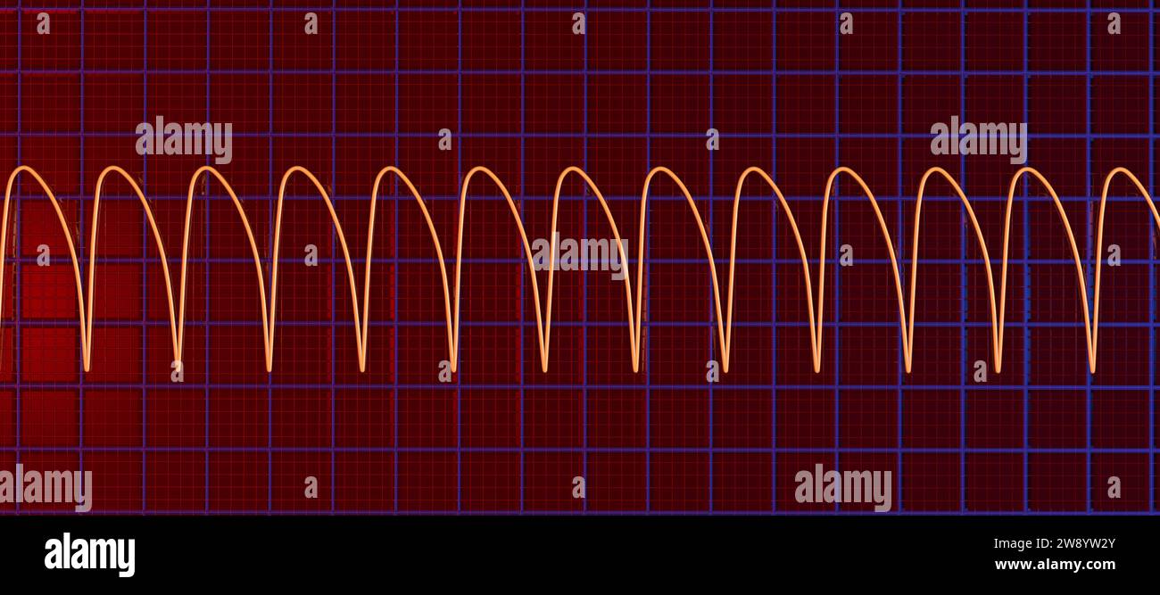 Tachicardia ventricolare ritmo cardiaco, illustrazione Foto Stock
