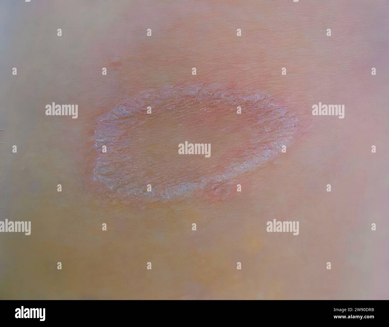Psoriasi malattia della pelle, vista primo piano Foto Stock