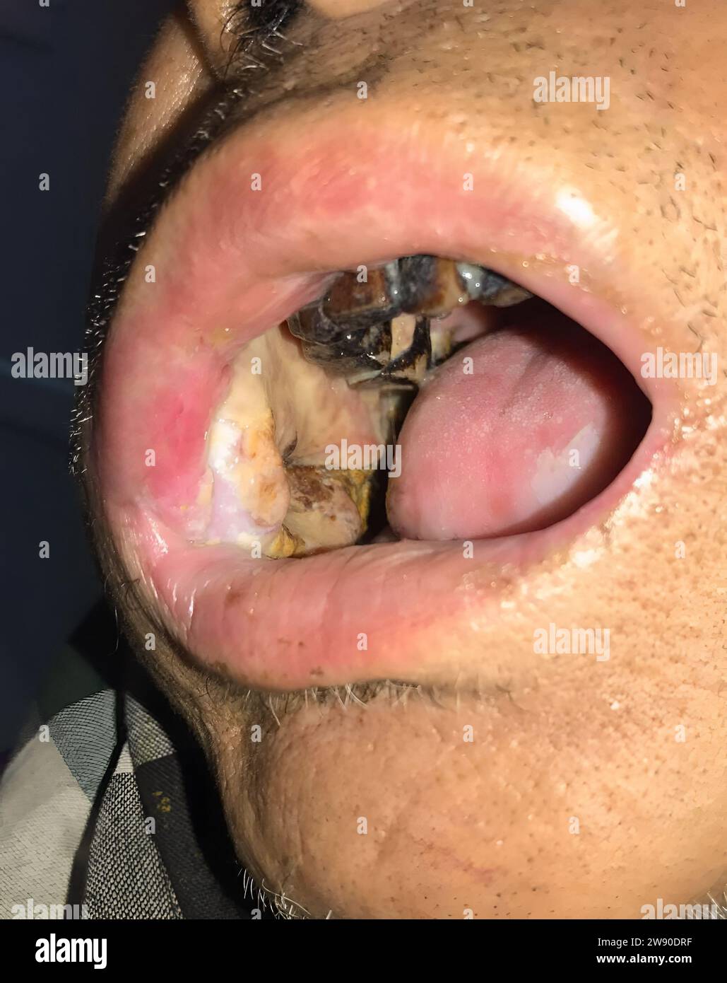 Ulcera cronica indolore nella superficie interna della guancia. Cancro orale o orale. Foto Stock