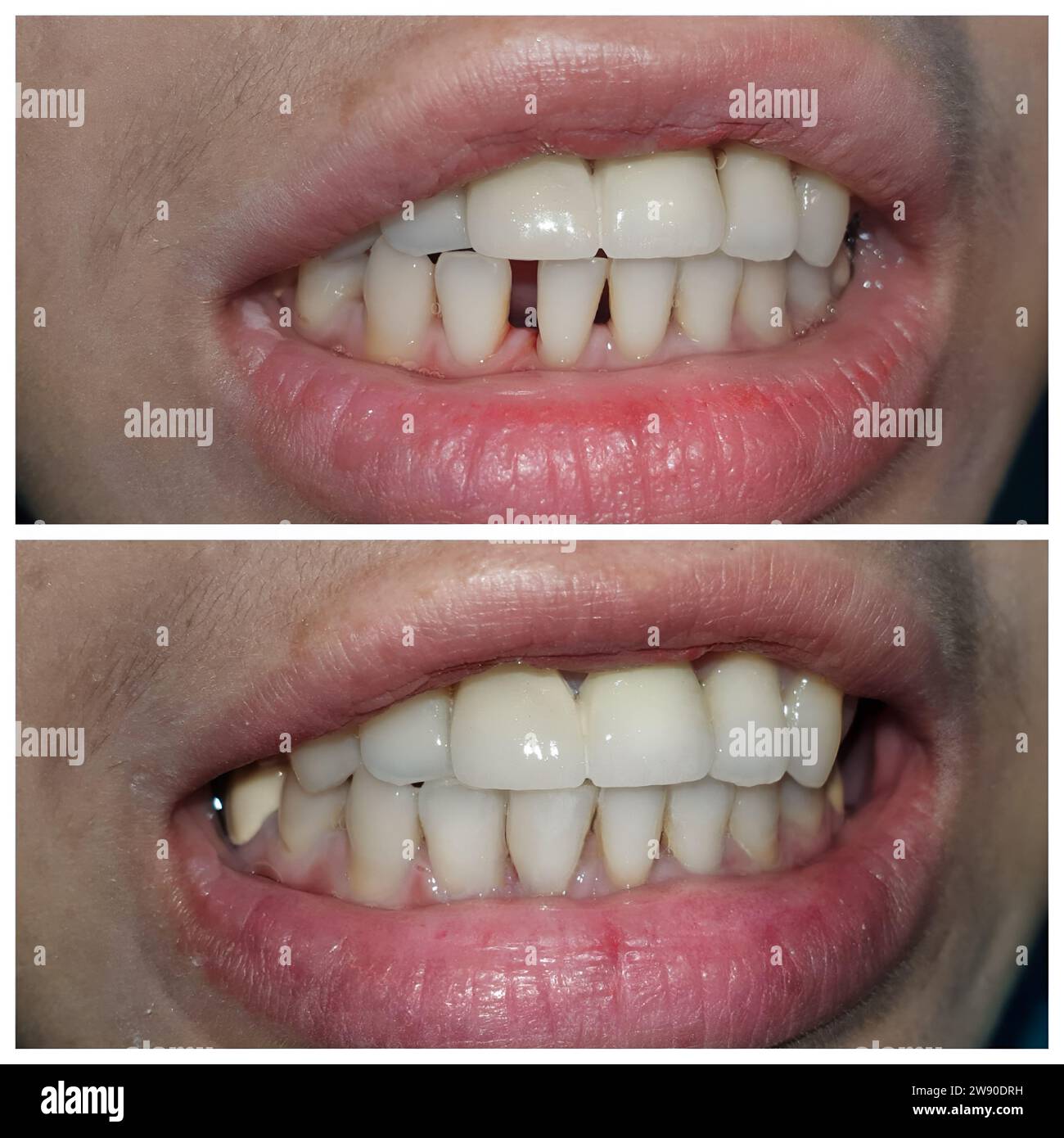 Prima e dopo la chiusura di un enorme divario tra i denti inferiori del paziente asiatico, diastema. Foto Stock