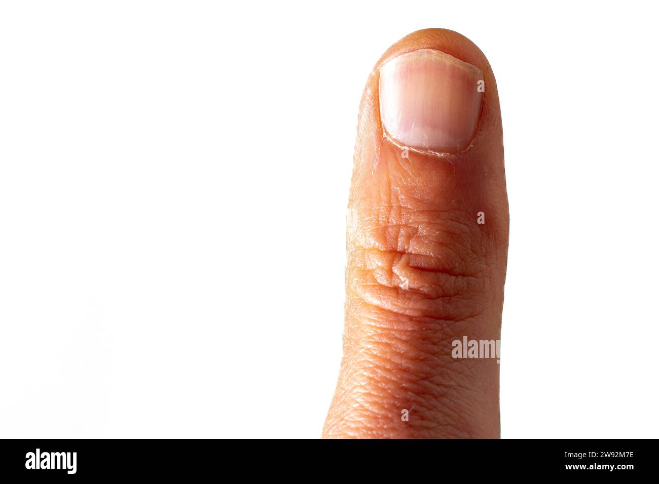 pollice di mano umana con unghia morsa da denti sotto sfondo bianco Foto Stock