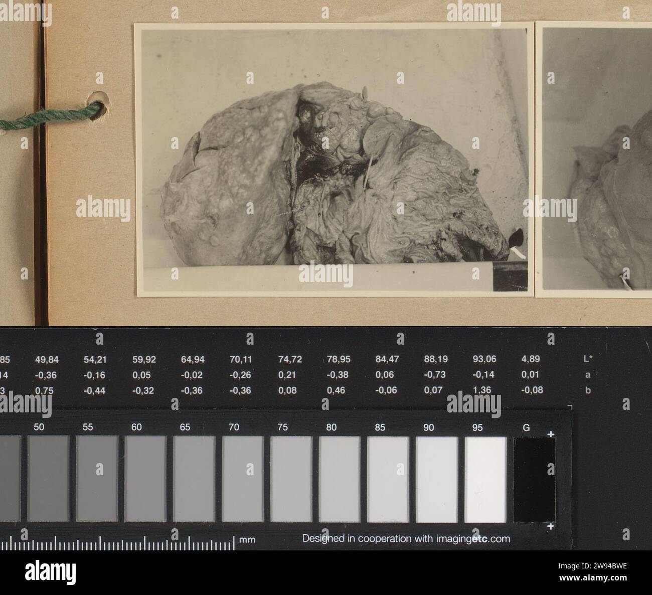 Anatomia patologica, 1929 Fotografia medica (a) di stomaco e fegato con tumori di un uomo di nome si Koewala Simbiring di circa 40-45 anni, dopo sezione nel dipartimento di anatomia patologica. Data della foto: 12 settembre 1929. Foto bloccata su un foglio di cartone prestampato rilegato nell'album fotografico del Batak Institute Hospituut a Kabanjaheh a Sumatra negli anni 1926-1929. Supporto fotografico Kabanjahe. Sumatra stampato in argento e gelatina di cartone Foto Stock