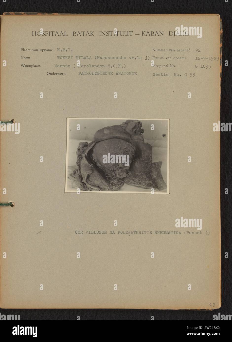 Anatomia patologica, 1929 Fotografia medica del cuore di una ragazza di nome Tourersi Milala di 14, dopo sezione, dopo sezione nel dipartimento di anatomia patologica. Data della foto: 12 settembre 1929. Foto bloccata su un foglio di cartone prestampato rilegato nell'album fotografico del Batak Institute Hospituut a Kabanjaheh a Sumatra negli anni 1926-1929. Supporto fotografico Kabanjahe. Sumatra stampato in argento e gelatina di cartone Foto Stock