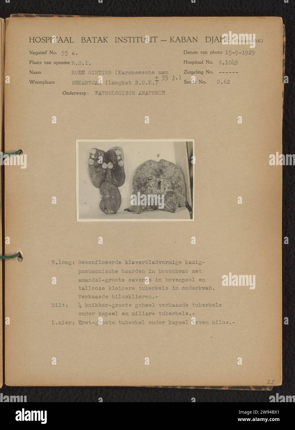 Anatomia patologica, 1929 Fotografia medica di polmone, milza e rene da un uomo di nome Roee Ginting di circa 35 anni, dopo sezione, dopo sezione nell'anatomia patologica. Data della foto: 15 settembre 1929. Foto bloccata su un foglio di cartone prestampato rilegato nell'album fotografico del Batak Institute Hospituut a Kabanjaheh a Sumatra negli anni 1926-1929. Supporto fotografico Kabanjahe. Sumatra stampato in argento e gelatina di cartone Foto Stock