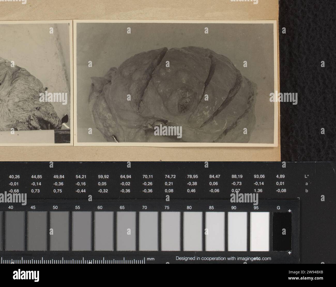 Anatomia patologica, 1929 Fotografia medica (B) di stomaco e fegato con tumori di un uomo di nome si Koewala Simbiring di circa 40-45 anni, dopo sezione nel dipartimento di anatomia patologica. Data della foto: 12 settembre 1929. Foto bloccata su un foglio di cartone prestampato rilegato nell'album fotografico del Batak Institute Hospituut a Kabanjaheh a Sumatra negli anni 1926-1929. Supporto fotografico Kabanjahe. Sumatra stampato in argento e gelatina di cartone Foto Stock
