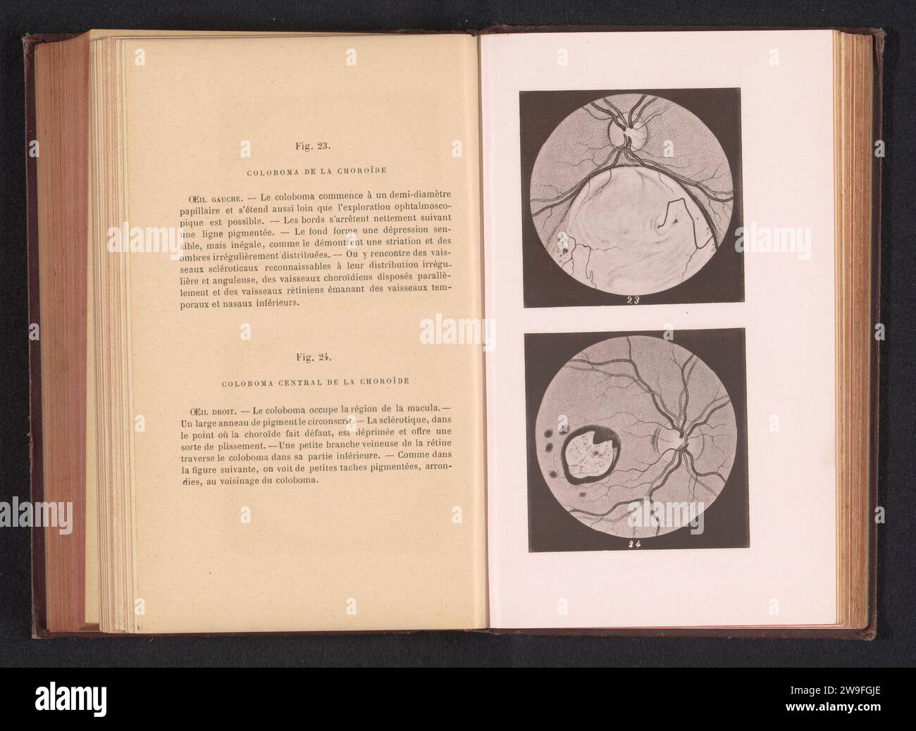 Produzione fotografica di due disegni anatomici di un foro nella membrana vascolare di un occhio, anonimo, c. 1871 - in o prima 1891 occhi collotipo di carta fotomeccanica stampa. anatomia (non medica) Foto Stock