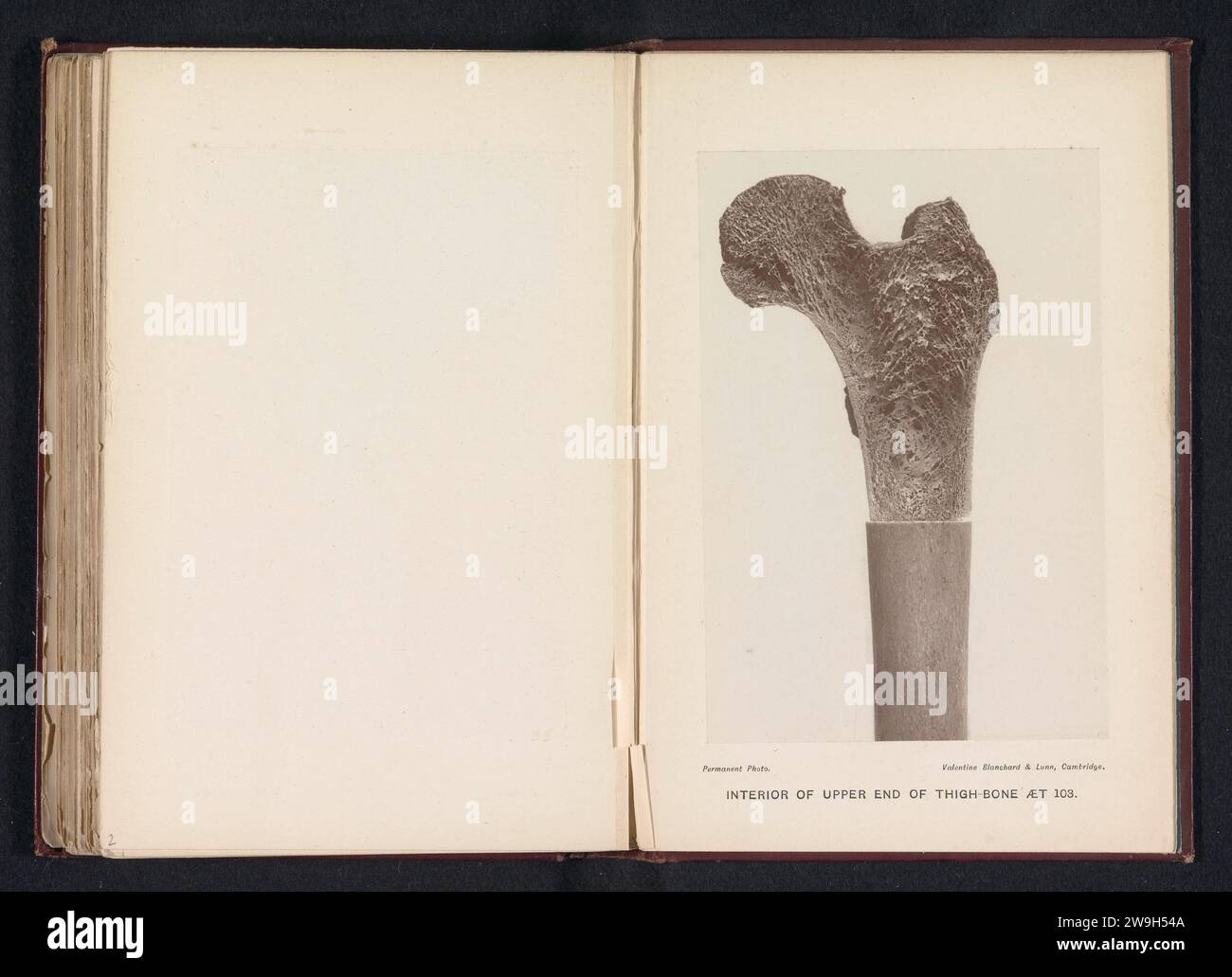 All'interno della parte superiore della coscia di qualcuno di 103 anni, anonimo, c. 1879 - in o prima del 1889 stampa fotomeccanica ossa di carta Cambridge in generale (corpo umano) Foto Stock