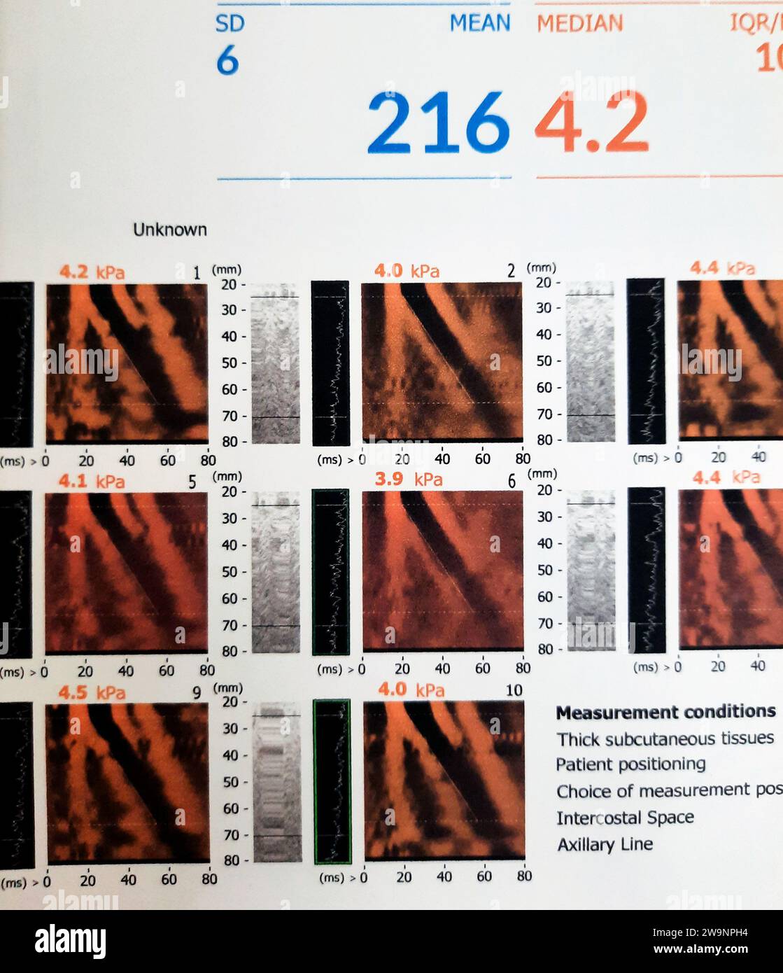 Lo studio di esame FibroScan del fegato ha rivelato F0 per la rigidità epatica, S0 per la steatosi epatica, lettura fibrosi 4,2 kPa, attenuazione cattura CAP pa Foto Stock