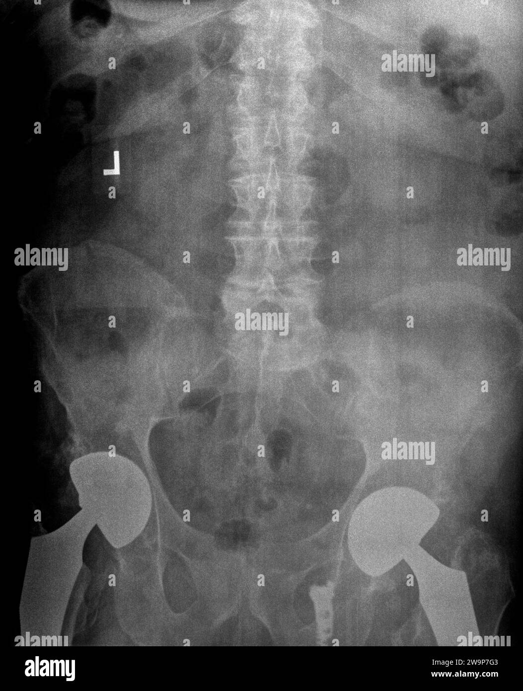 Pellicola radiografica o radiografia di una colonna lombare, pelvi e anca. Vista anteriore posteriore AP che mostra un intervento chirurgico bilaterale di sostituzione dell'anca con viti in titanio Foto Stock