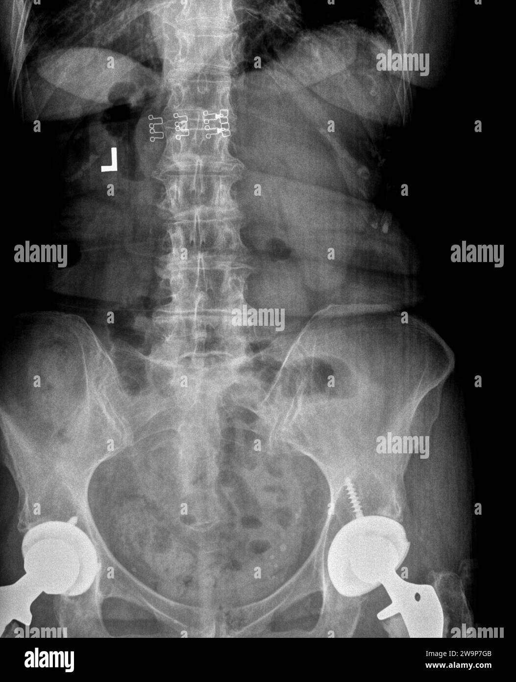 Pellicola radiografica o radiografia di una colonna lombare, pelvi e anca. Vista anteriore posteriore AP che mostra un intervento chirurgico bilaterale di sostituzione dell'anca con viti in titanio Foto Stock