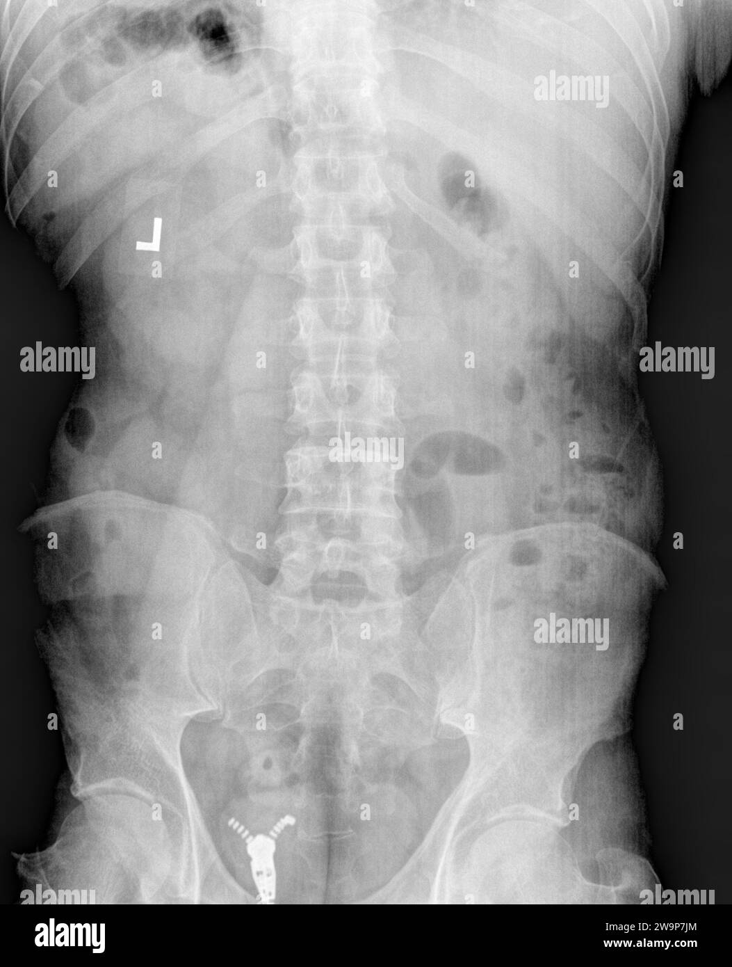 Pellicola radiografica o radiografia di una normale vista AP anteriore posteriore anteriore posteriore delle vertebre lombari per adulti che mostra una struttura ossea normale Foto Stock