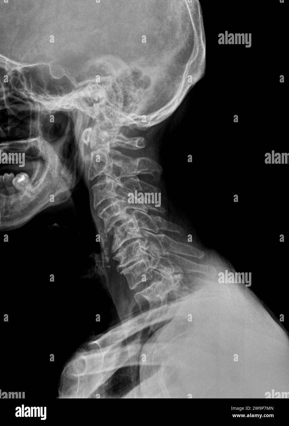 Pellicole radiografiche o radiografie di un collo cervicale in un paziente anziano. Vista laterale che mostra un raddrizzamento o una lieve cifosi normalmente osservata dopo un wh Foto Stock