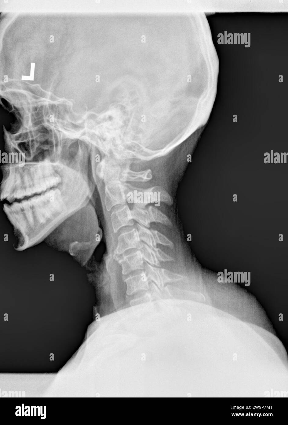 Pellicola radiografica o radiografia di un collo cervicale. Vista laterale che mostra un raddrizzamento o una lieve cifosi normalmente osservata dopo una lesione da colpo di frusta con gradi Foto Stock
