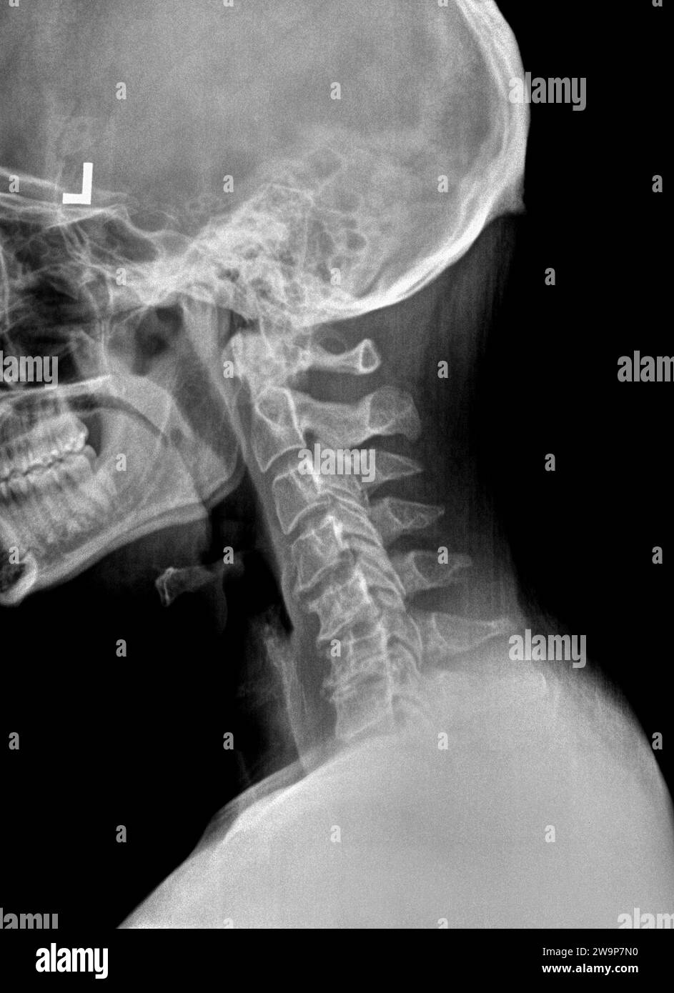 Pellicola radiografica o radiografia di un collo cervicale. Vista laterale che mostra un raddrizzamento o una lieve cifosi normalmente osservata dopo una lesione da colpo di frusta con gradi Foto Stock