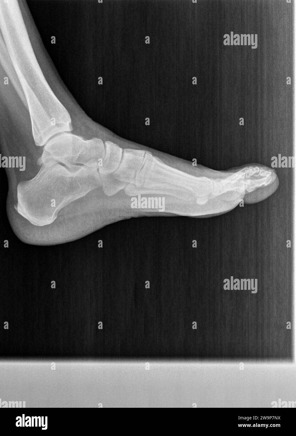 Pellicola radiografica o radiografia di un piede, una caviglia e una gamba normali. La vista laterale mostra che la struttura ossea normale dello spazio articolare è normale Foto Stock