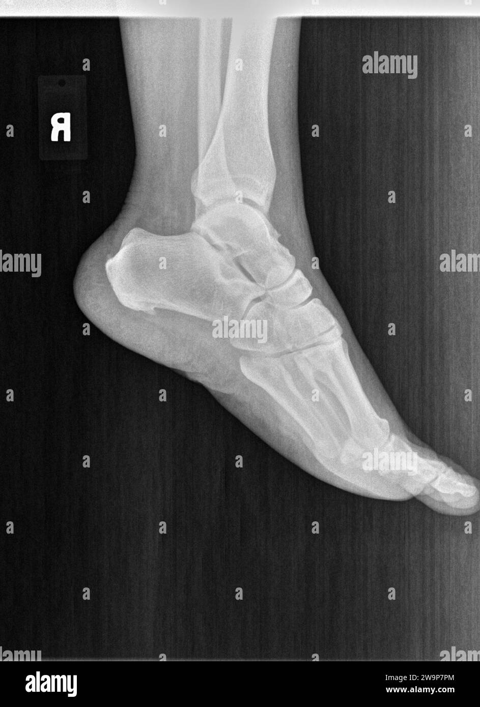 Pellicola radiografica o radiografia di un piede, una caviglia e una gamba normali. La vista laterale mostra che la struttura ossea normale dello spazio articolare è normale Foto Stock