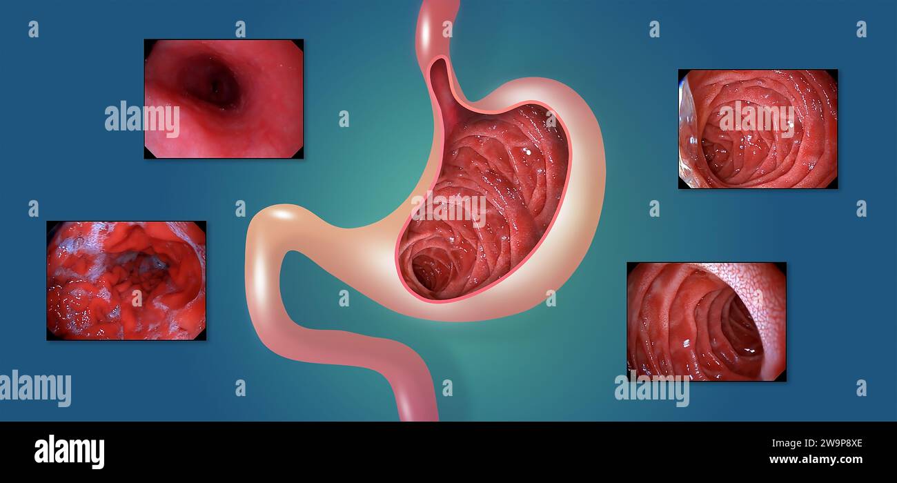 Mucosa gastrica. Endoscopia digestiva o gastroscopia. Esecuzione di una procedura di gastroscopia. Diagnosi di malattie gastriche. Salute dello stomaco. Conce medico Foto Stock
