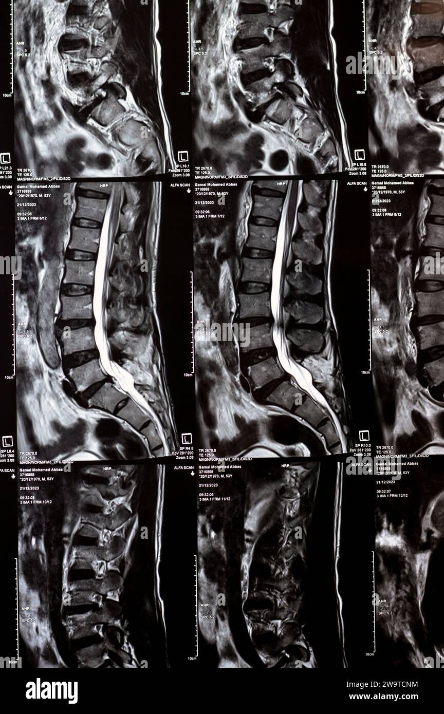 Cairo, Egitto, 24 dicembre 2023: Evidenza di laminectomia spinale delle vertebre L5, decompressione del sacco thecale posteriore, spondilosi lombare, protr. Disco posteriore Foto Stock